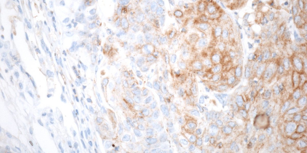 CIC bioGUNE cáncer próstata