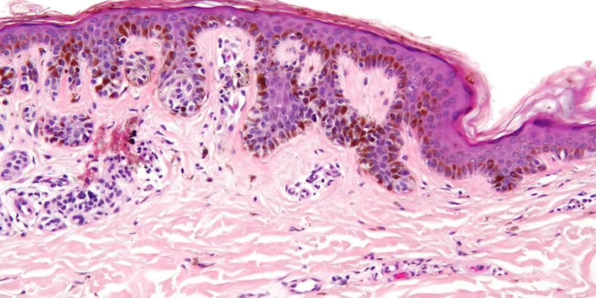 Imagen microscópica de un melanoma, uno de los cánceres más graves que se representa en la piel.