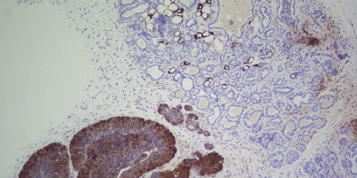 Imagen de inmunohistoquímica de FASN en una mama de ratón transgénico que desarrolla tumores de mama. En marrón oscuro, las zonas donde FASN está presente desarrollan tumores. En azul, ductos mamarios normales sin FASN y sin tumor. / CNIO